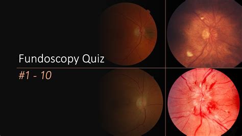 fundoscopy findings|fundoscopy quiz.